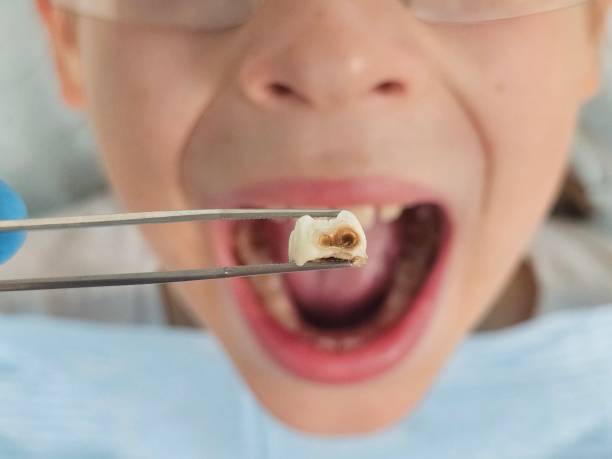 Best Chipped Tooth Repair Near Me  in Pleasant Hill, OH
